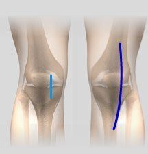 minimally-knee-replacement